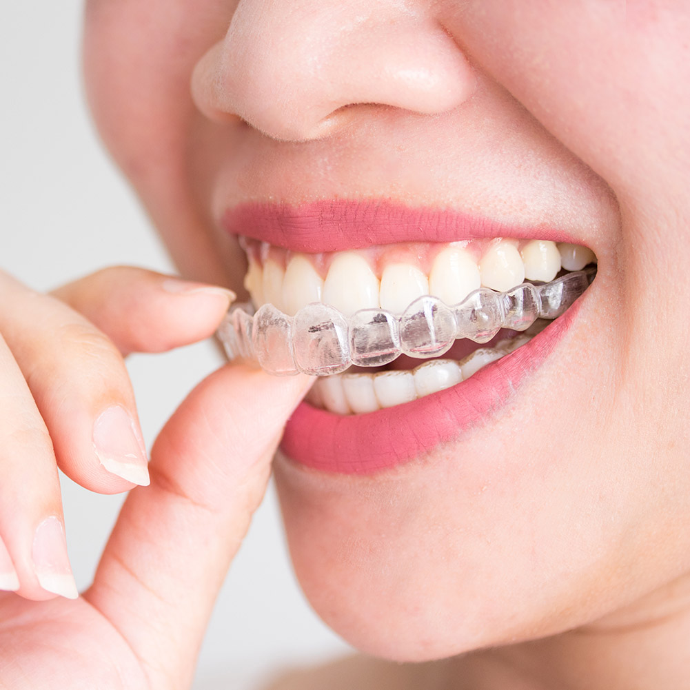 2/4pcs Professional Tooth Orth - Teeth Whitening Retainer ulasan dan harga