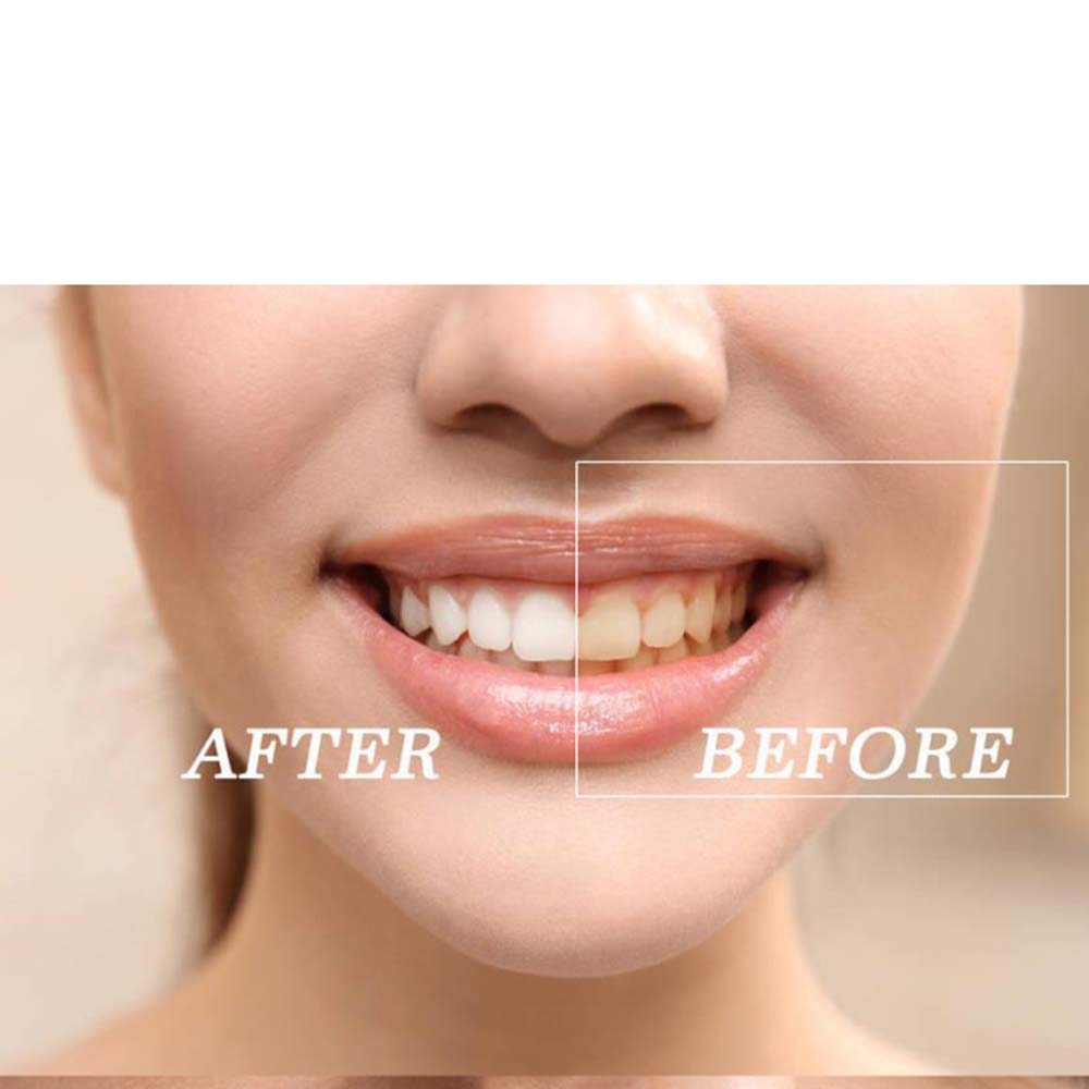 Top Quality Peroxide Teeth Whi - Teeth Whitening Gel Peroxide ulasan dan harga