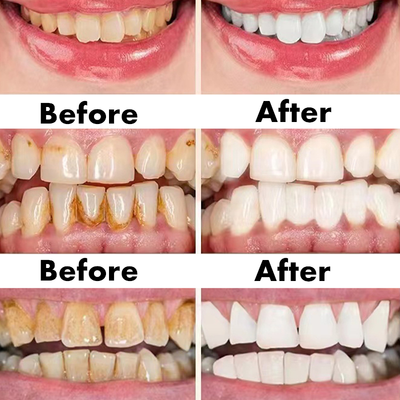 Teeth Whitening Pen Dental Ess - Whitening Pen Bleach ulasan dan harga