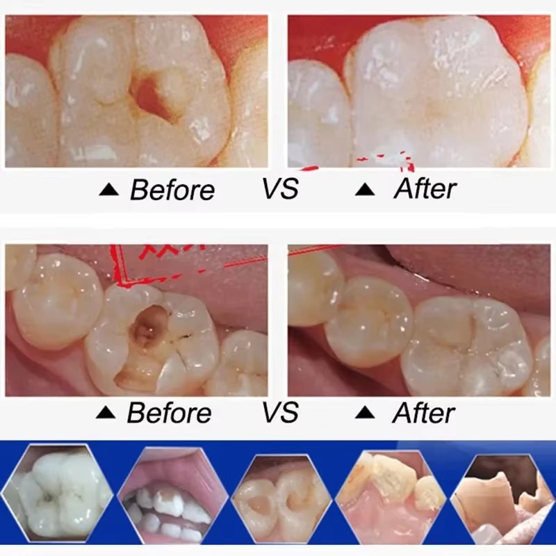 Permanent Dental Teeth Glue Ce - Teeth Whitening Uv Kit ulasan dan harga