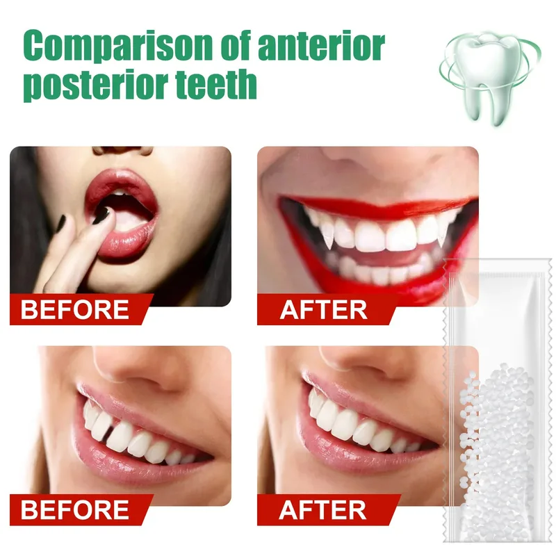 Temporary Tooth Repair Kit Tee - Teeth Whitening Uv Kit ulasan dan harga